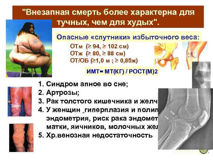 "Внезапная смерть более характерна для тучных, чем для худых". Опасные «спутники» избыточного веса: ОТм