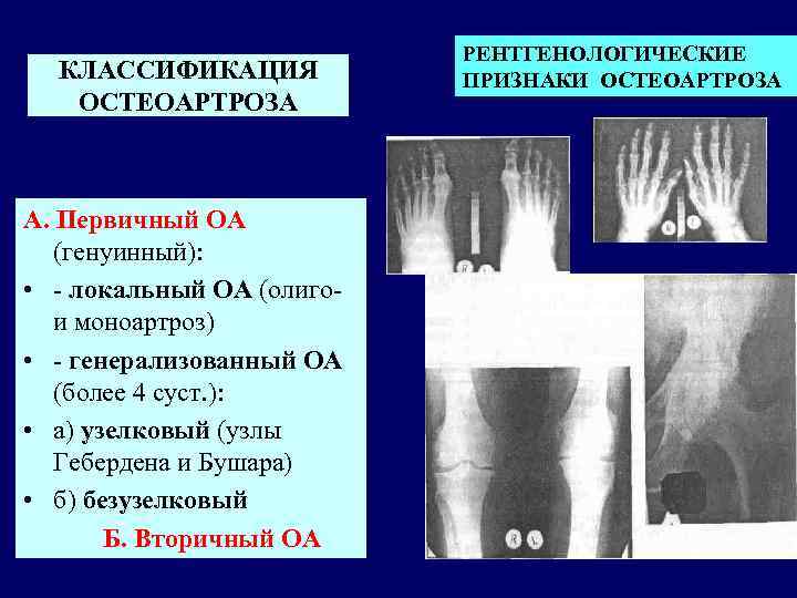 КЛАССИФИКАЦИЯ ОСТЕОАРТРОЗА А. Первичный ОА (генуинный): • - локальный ОА (олиго- и моноартроз) •