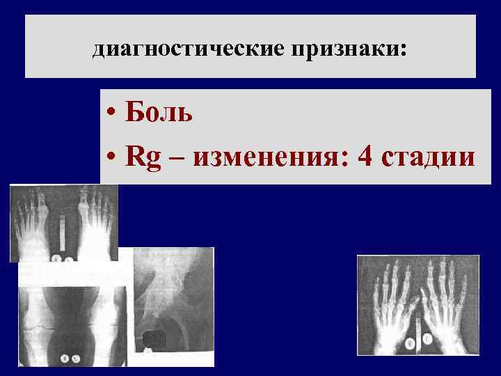 диагностические признаки: • Боль • Rg – изменения: 4 стадии 