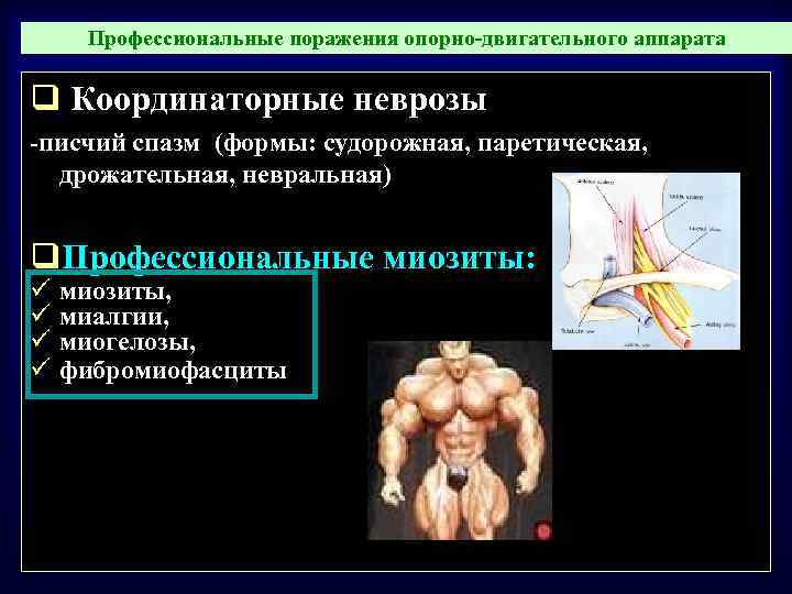 Профессиональные болезни опорно двигательного аппарата презентация