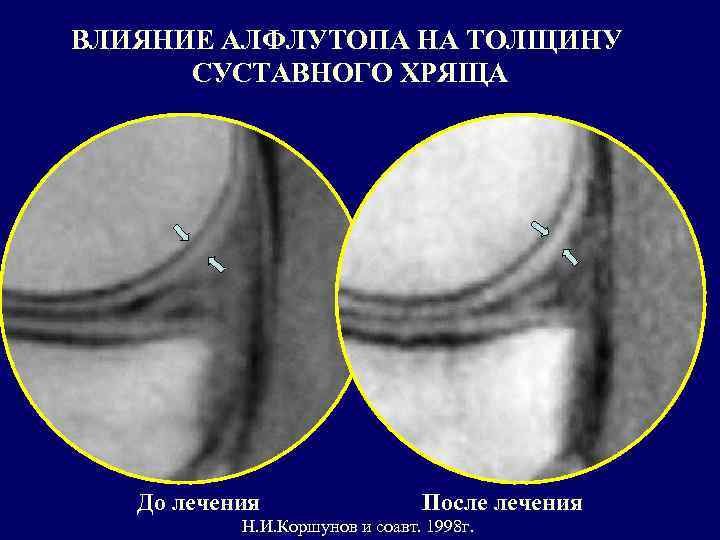 ВЛИЯНИЕ АЛФЛУТОПА НА ТОЛЩИНУ СУСТАВНОГО ХРЯЩА До лечения После лечения Н. И. Коршунов и