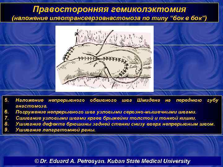 Правосторонняя гемиколэктомия (наложение илеотрансверзоанастомоза по типу “бок в бок”) 5. 6. 7. 8. 9.