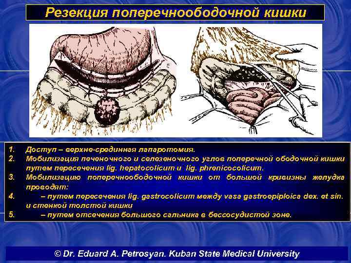 Резекция поперечноободочной кишки 1. 2. 3. 4. 5. Доступ – верхне-срединная лапаротомия. Мобилизация печеночного