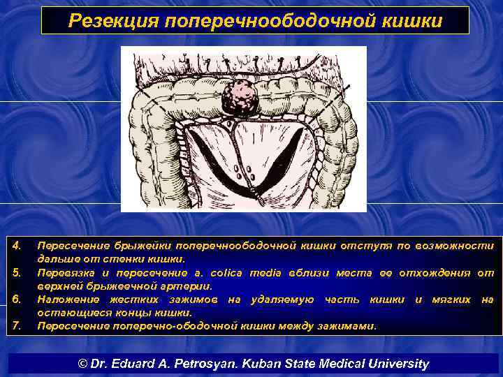 Резекция поперечноободочной кишки 4. 5. 6. 7. Пересечение брыжейки поперечноободочной кишки отступя по возможности