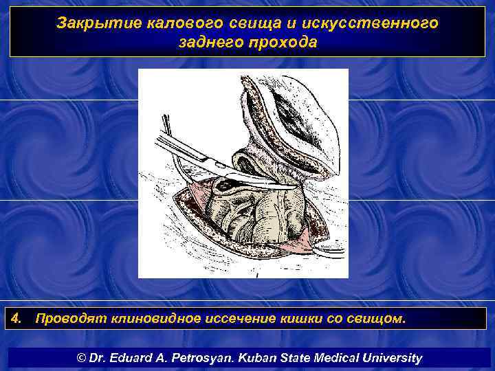Закрытие калового свища и искусственного заднего прохода 4. Проводят клиновидное иссечение кишки со свищом.