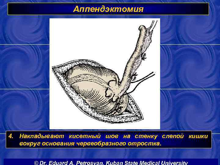 Аппендэктомия 4. Накладывают кисетный шов на стенку слепой кишки вокруг основания червеобразного отростка. 