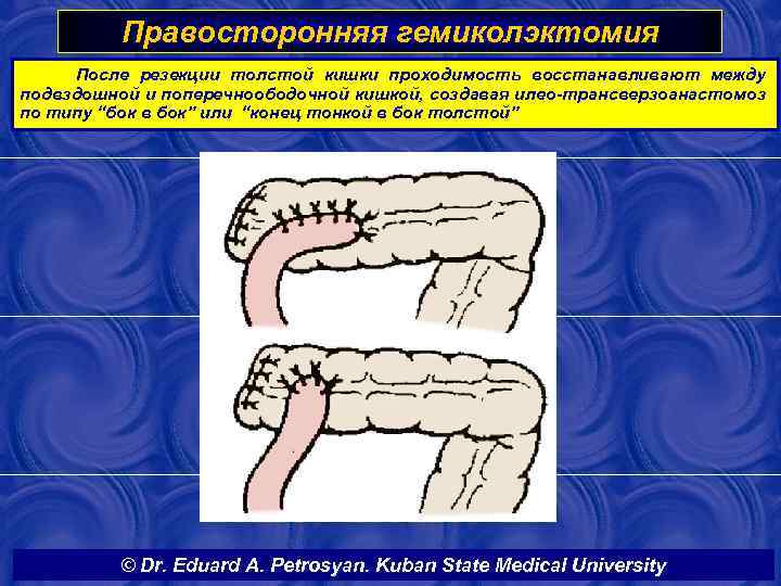 Правосторонняя гемиколэктомия После резекции толстой кишки проходимость восстанавливают между подвздошной и поперечноободочной кишкой, создавая