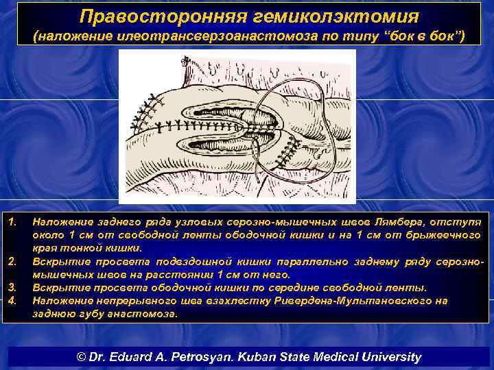 Правосторонняя гемиколэктомия (наложение илеотрансверзоанастомоза по типу “бок в бок”) 1. 2. 3. 4. Наложение