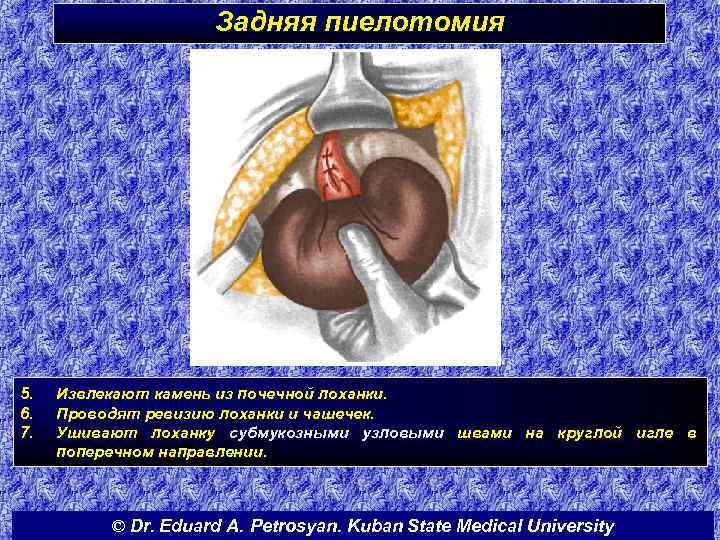 Задняя пиелотомия 5. 6. 7. Извлекают камень из почечной лоханки. Проводят ревизию лоханки и