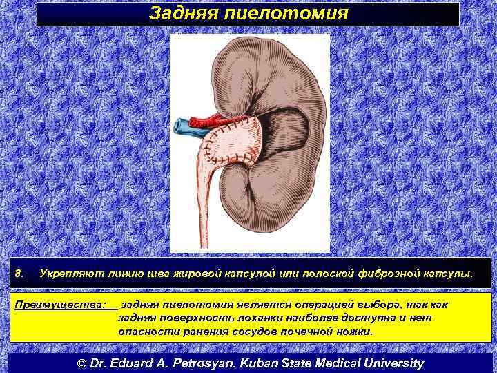 Задняя пиелотомия 8. Укрепляют линию шва жировой капсулой или полоской фиброзной капсулы. Преимущества: задняя