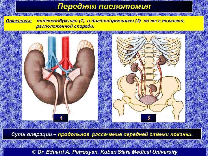 Передняя пиелотомия Показания: подковообразная (1) и дистопированная (2) почка с лоханкой, расположенной спереди. 1