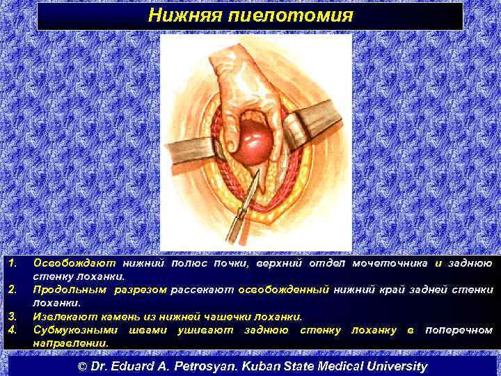 Нижняя пиелотомия 1. 2. 3. 4. Освобождают нижний полюс почки, верхний отдел мочеточника и