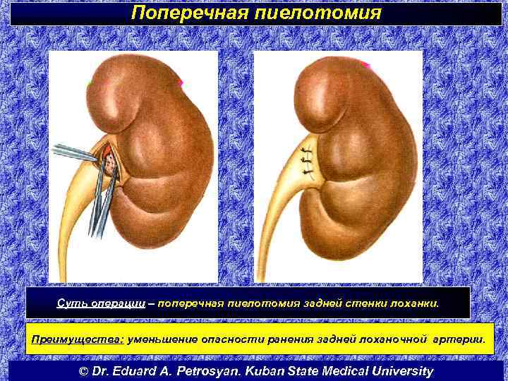 Поперечная пиелотомия Суть операции – поперечная пиелотомия задней стенки лоханки. Преимущества: уменьшение опасности ранения