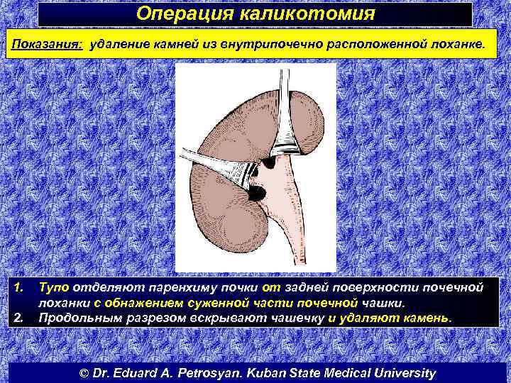Операция каликотомия Показания: удаление камней из внутрипочечно расположенной лоханке. 1. 2. Тупо отделяют паренхиму