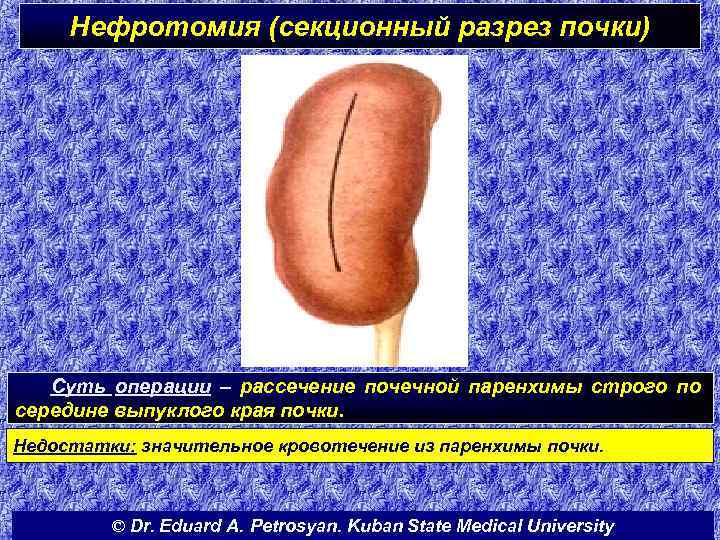 Нефротомия (секционный разрез почки) Суть операции – рассечение почечной паренхимы строго по середине выпуклого