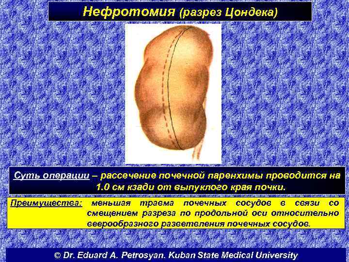 Нефротомия (разрез Цондека) Суть операции – рассечение почечной паренхимы проводится на 1. 0 см