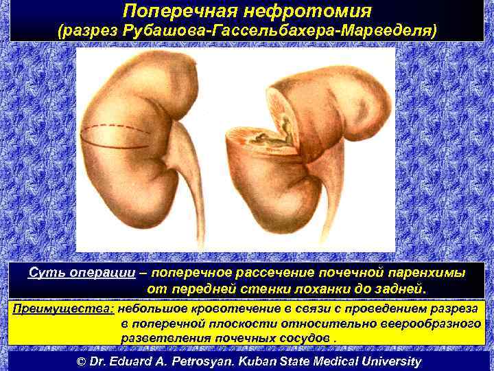 Поперечная нефротомия (разрез Рубашова-Гассельбахера-Марведеля) Суть операции – поперечное рассечение почечной паренхимы от передней стенки