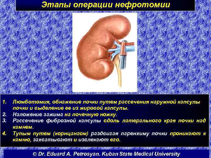 Этапы операции нефротомии 1. 2. 3. 4. Люмботомия, обнажение почки путем рассечения наружной капсулы