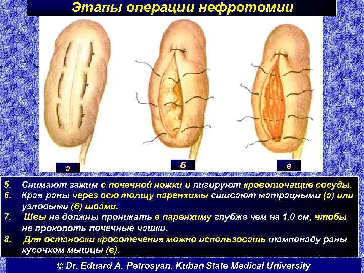 Этапы операции нефротомии а 5. 6. 7. 8. б в Снимают зажим с почечной