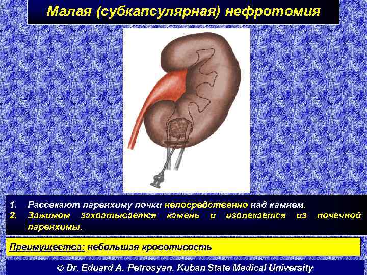 Малая (субкапсулярная) нефротомия 1. 2. Рассекают паренхиму почки непосредственно над камнем. Зажимом захватывается камень