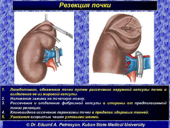 Резекция почки 1. 2. 3. 4. 5. Люмботомия, обнажение почки путем рассечения наружной капсулы
