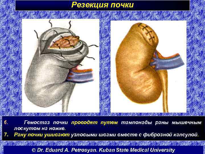 Резекция почки 6. 7. Гемостаз почки проводят путем тампонады раны мышечным лоскутом на ножке.