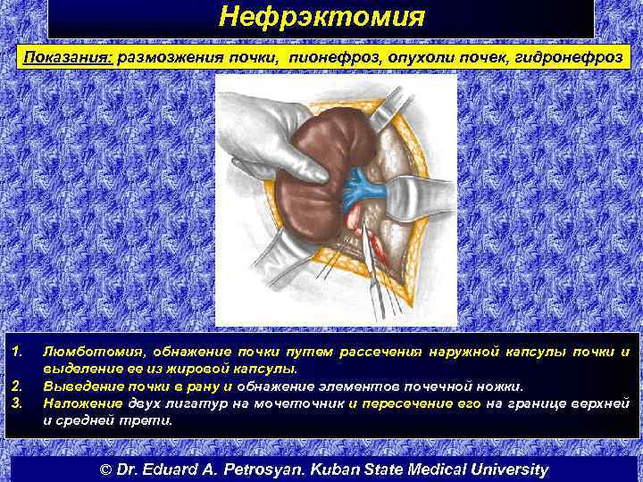 Нефрэктомия Показания: размозжения почки, пионефроз, опухоли почек, гидронефроз 1. 2. 3. Люмботомия, обнажение почки