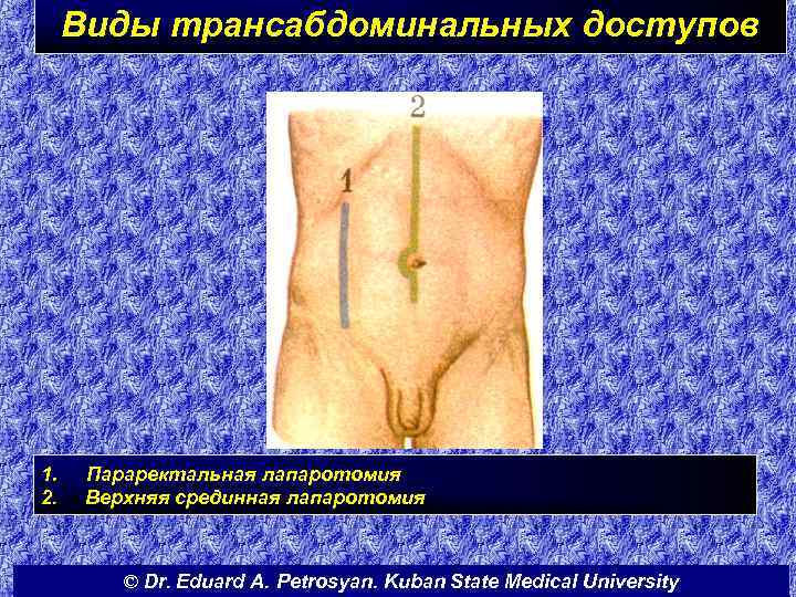 Виды трансабдоминальных доступов 1. 2. Параректальная лапаротомия Верхняя срединная лапаротомия © Dr. Eduard A.