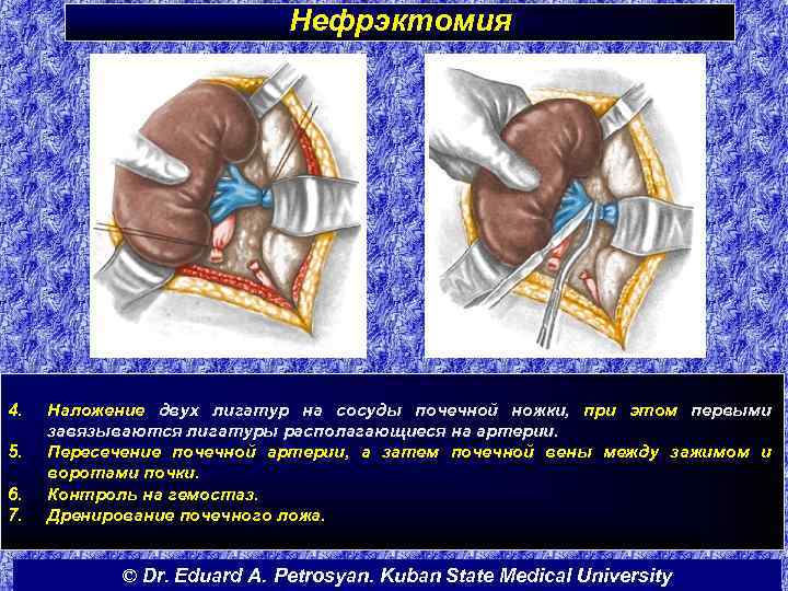 Нефрэктомия 4. 5. 6. 7. Наложение двух лигатур на сосуды почечной ножки, при этом