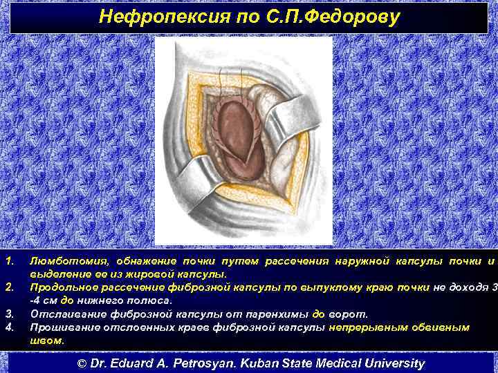 Нефропексия по С. П. Федорову 1. 2. 3. 4. Люмботомия, обнажение почки путем рассечения