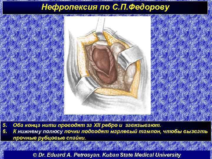 Нефропексия по С. П. Федорову 5. 6. Оба конца нити проводят за XII ребро