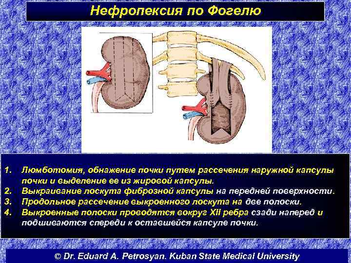 Нефропексия по Фогелю 1. 2. 3. 4. Люмботомия, обнажение почки путем рассечения наружной капсулы