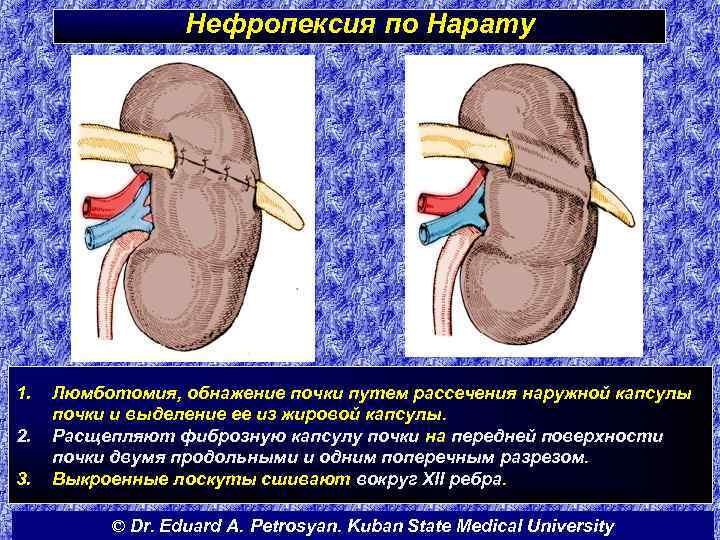 Нефропексия по Нарату 1. 2. 3. Люмботомия, обнажение почки путем рассечения наружной капсулы почки