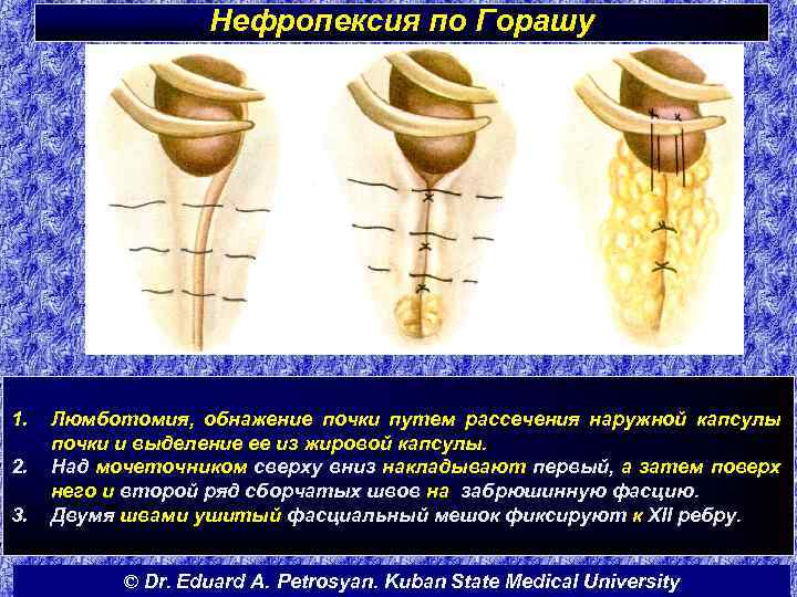 Нефропексия по Горашу 1. 2. 3. Люмботомия, обнажение почки путем рассечения наружной капсулы почки