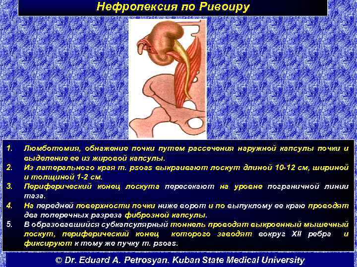 Нефропексия по Ривоиру 1. 2. 3. 4. 5. Люмботомия, обнажение почки путем рассечения наружной
