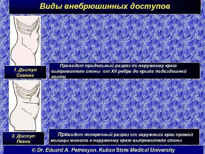 Виды внебрюшинных доступов 1. Доступ Симона 2. Доступ Пеана Проводят продольный разрез по наружному