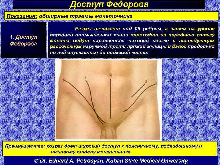 Доступ Федорова Показания: обширные травмы мочеточника 1. Доступ Федорова Разрез начинают под XII ребром,