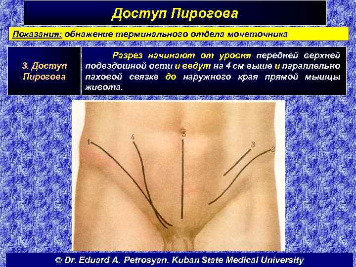Доступ Пирогова Показания: обнажение терминального отдела мочеточника 3. Доступ Пирогова Разрез начинают от уровня
