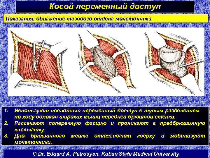 Косой переменный доступ Показания: обнажение тазового отдела мочеточника 1. 2. 3. Используют послойный переменный