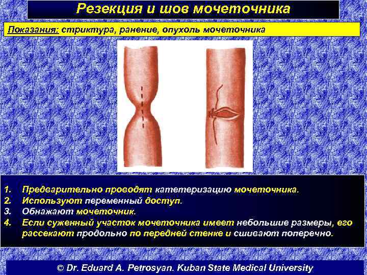 Резекция и шов мочеточника Показания: стриктура, ранение, опухоль мочеточника 1. 2. 3. 4. Предварительно