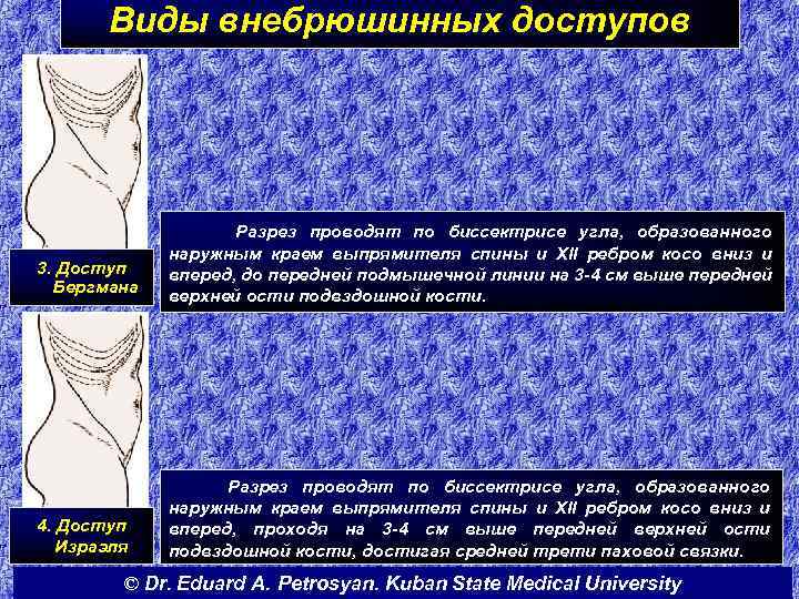 Виды внебрюшинных доступов 3. Доступ Бергмана Разрез проводят по биссектрисе угла, образованного наружным краем