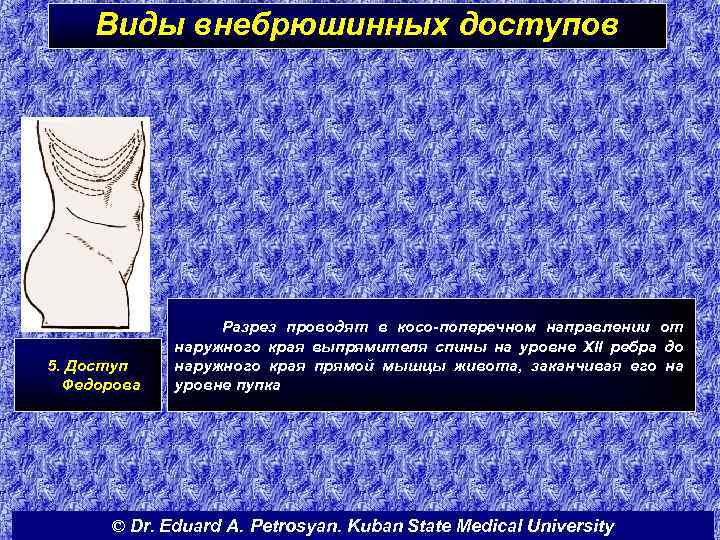 Виды внебрюшинных доступов 5. Доступ Федорова Разрез проводят в косо-поперечном направлении от наружного края