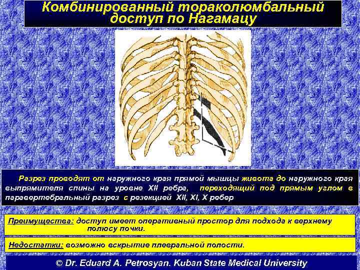 Комбинированный тораколюмбальный доступ по Нагамацу Разрез проводят от наружного края прямой мышцы живота до