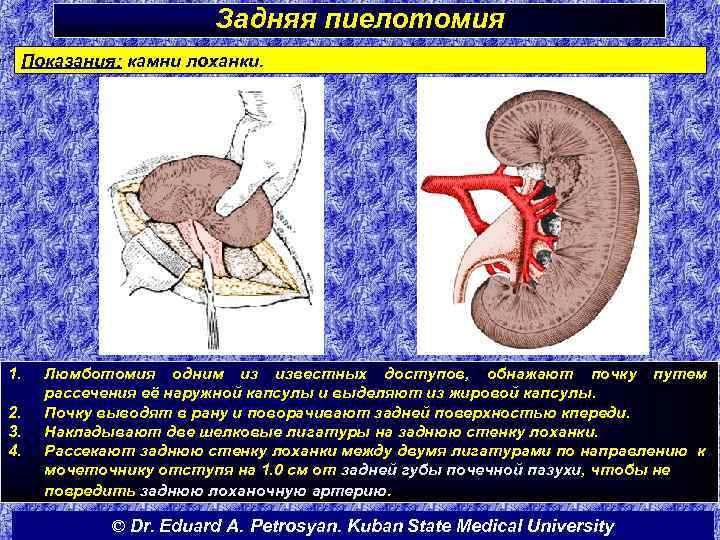 Задняя пиелотомия Показания: камни лоханки. 1. 2. 3. 4. Люмботомия одним из известных доступов,