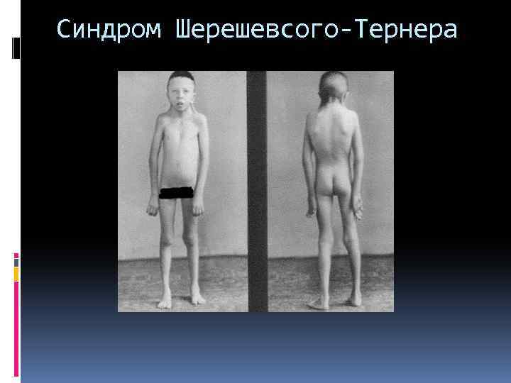 Синдром Шерешевсого-Тернера 