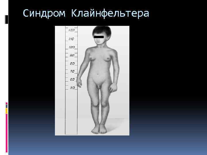 Синдром Клайнфельтера 