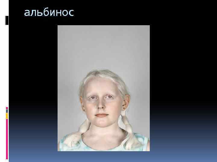 альбинос 