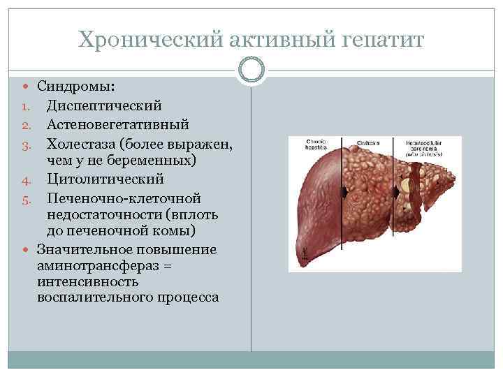 Хронический активный гепатит Синдромы: 1. 2. 3. 4. 5. Диспептический Астеновегетативный Холестаза (более выражен,