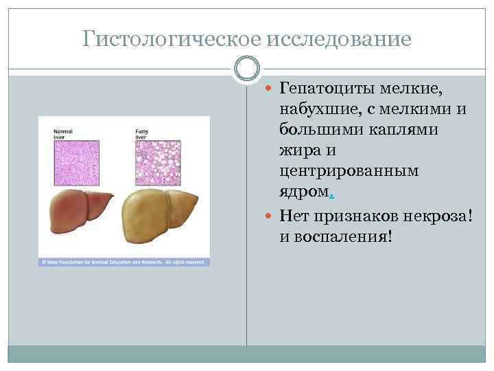 Гистологическое исследование Гепатоциты мелкие, набухшие, с мелкими и большими каплями жира и центрированным ядром.