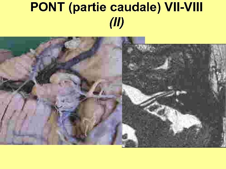 PONT (partie caudale) VII-VIII (II) 